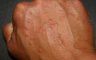 Причины и лечение сыпи на руках в виде пузырьков