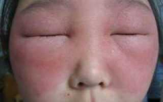 Аллергические реакции на лице