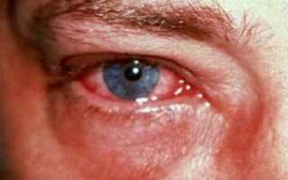 Аллергический отек глаз (век)