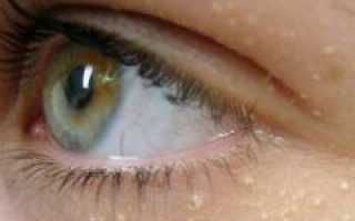 Жировики вокруг глаз и как от них избавиться