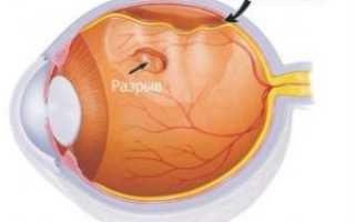 Как лечить отслоение сетчатки глаза