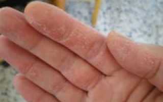 Что делать, если облазит кожа на пальцах рук, и почему это происходит
