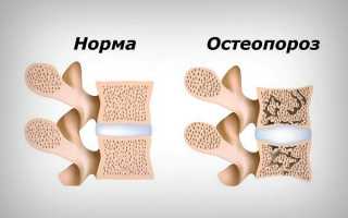 Остеопороз костей: все о заболевании