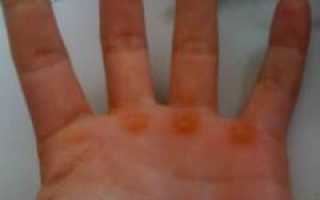 Причины и методы лечения мозолей на пальцах рук