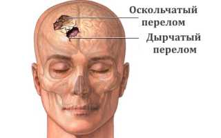 Перелом лобной кости: особенности повреждения