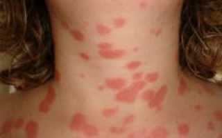 Основные причины появления красных пятен на коже