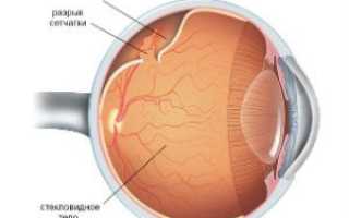 Что такое отслоение сетчатки глаза