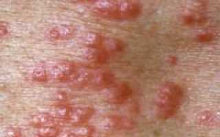 Причины и лечение сыпи на коже