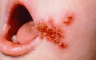 Стрептококковая инфекция на коже