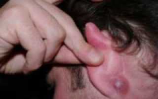 Причины сыпи за ушами