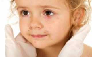 Причины и лечение сыпи на коже у ребенка