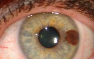 Что такое меланома глаза