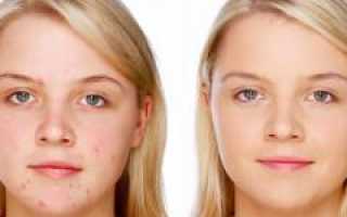 Как лечить проблемную кожу лица