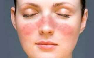 Рожистое воспаление кожи лица