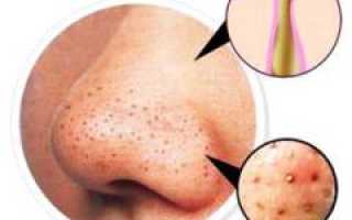 Черные точки на носу и их лечение