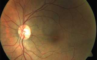 Ангиопатия сосудов сетчатки глаза у ребенка – что это такое?