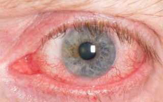 Вирусные заболевания глаз