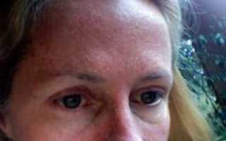 Причины шелушения кожи на лице