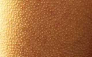 Что такое гусиная кожа у человека