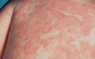 Причины и лечение красной сыпи на коже