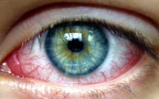 Болят ли глаза при коронавирусе