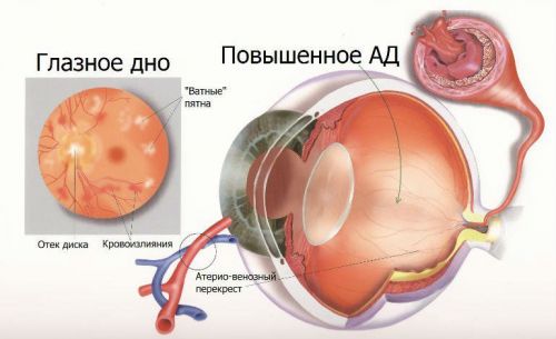 Гипертоническая ангиопатия