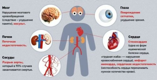 Ангиосклероз сетчатки глаза