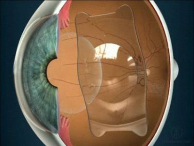 Факичная линза внутри глаза