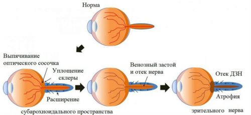 Отек зрительного нерва