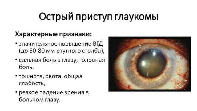 Признаки приступа глаукомы