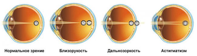 Близорукость, дальнозиркость, астигматизм