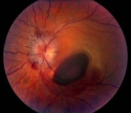 Внутренне кровоизлияние при исследовании глазного дна