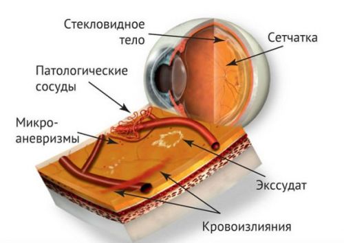 Диабетическая ретинопатия