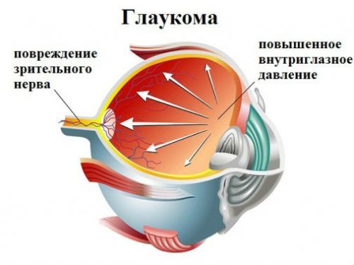 Глаукома