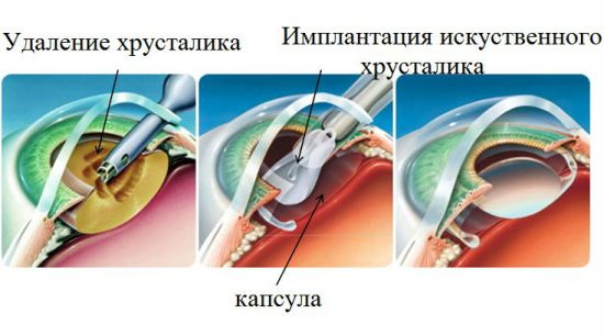 Ход операции по ленсэктомии