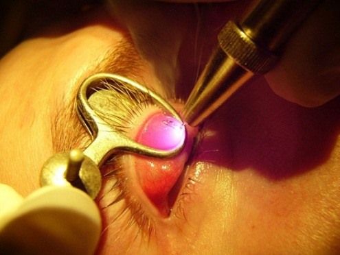 Лазерное удаление халязиона