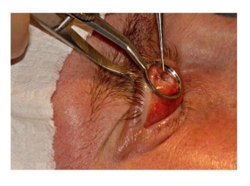 Выскабливание халязиона кюреткой