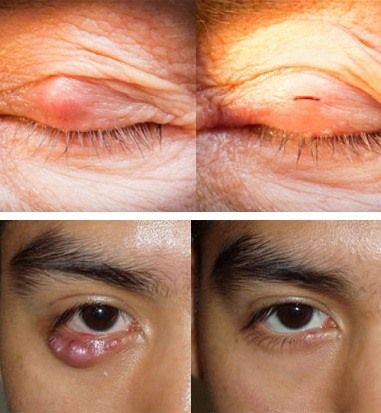 после удаления халязилна