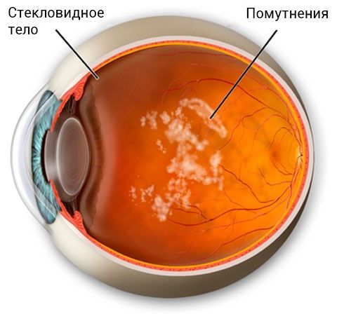 Деструкция стекловидного тела