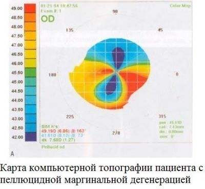 КТ глаза