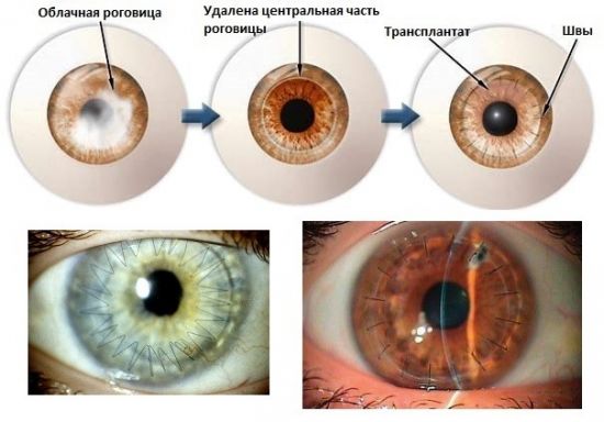 Схема операции по пересадке роговицы