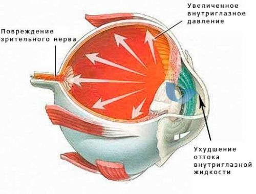 Опасности глаукомы