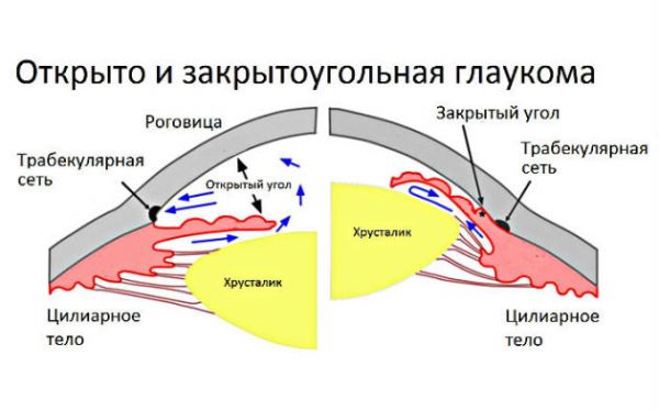 Глаукома