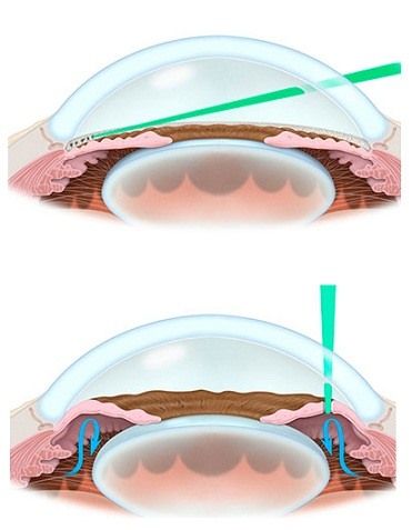 Лазерная периферическая иридотомия