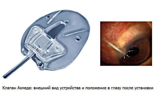 Операция при глаукоме