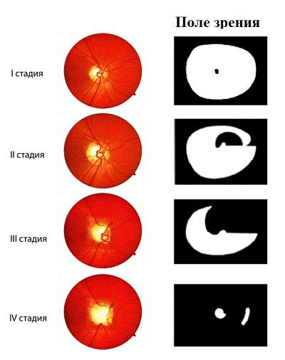 Поля зрения при глаукоме