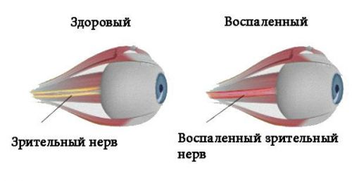 Неврит зрительного нерва