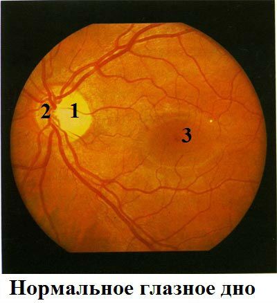 Сужение сосудов глаз. Офтальмоскопия глазного дна. Офтальмоскопия глазного дна норма. Нанофтальм глазное дно.