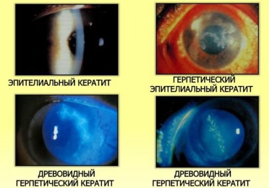 Виды кератита