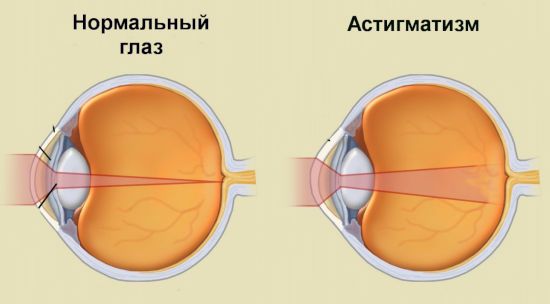 Астигматизм